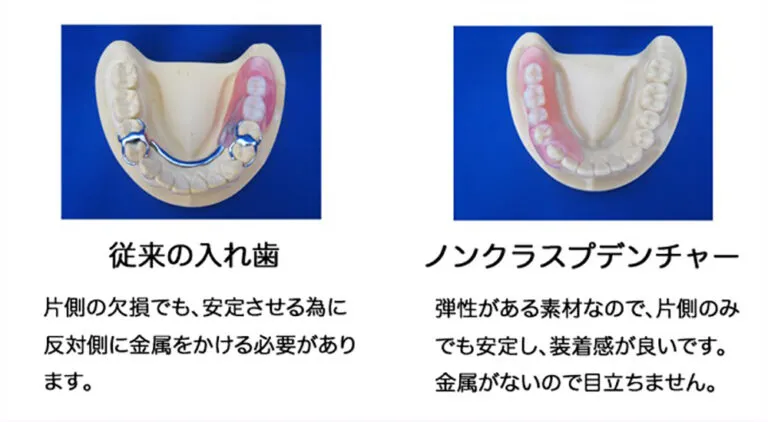 ノンクラスプデンチャー
