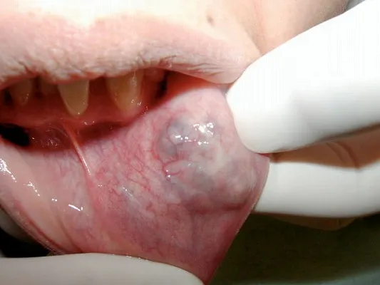 血管腫