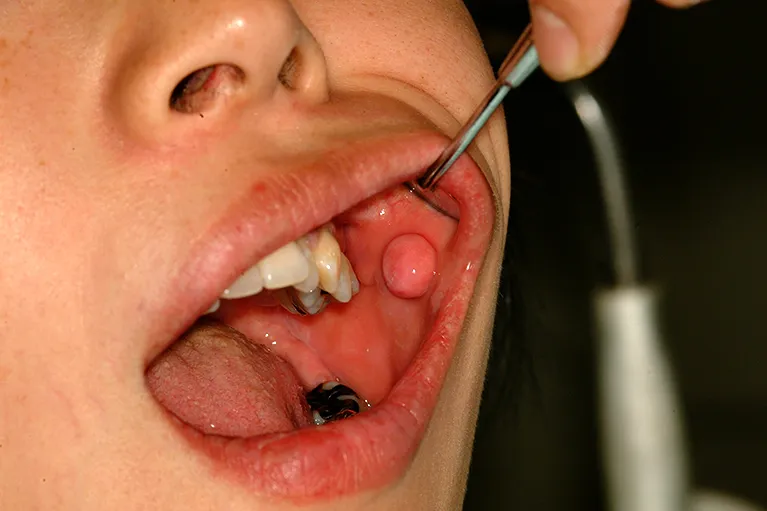 繊維腫