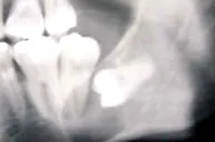 嚢胞(歯根嚢胞・顎骨嚢胞)
