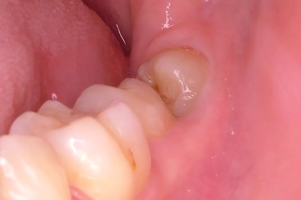 自分の親知らずを使う「歯牙移植」